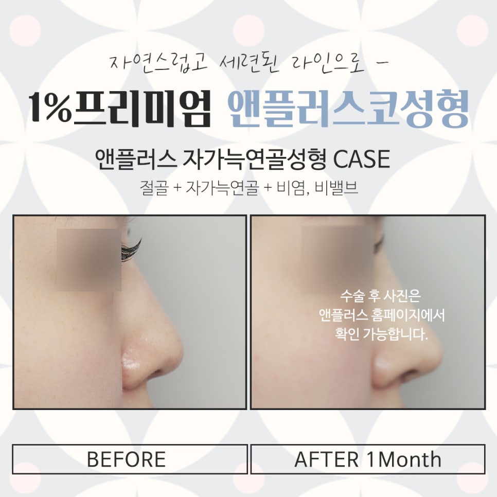 자가늑코성형에 대해 다양하게 알아보고 관련 이미지 15