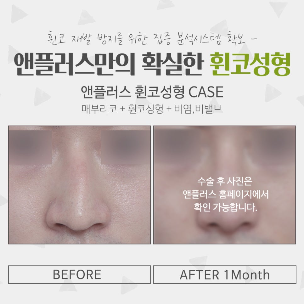 Whistling Nose Surgery Review: A Natural and Beautiful Line image 13