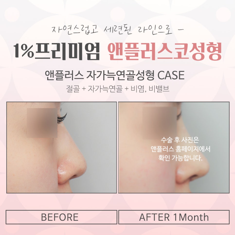 If You Want to Learn About Autologous Rib Cartilage Nose Surgery Accurately image 14