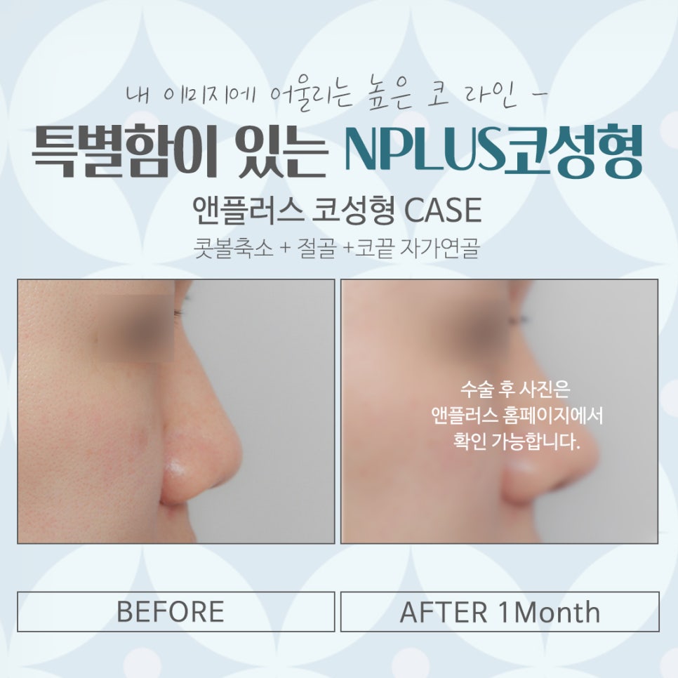 코성형잘하는병원 자연스러운 라인으로 관련 이미지 15