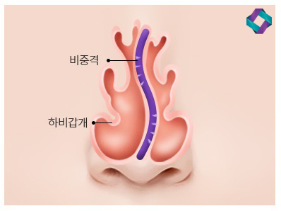 늑연골 코성형 : 자가연골의 장점과 단점 (자가연골 비교) 관련 이미지 4