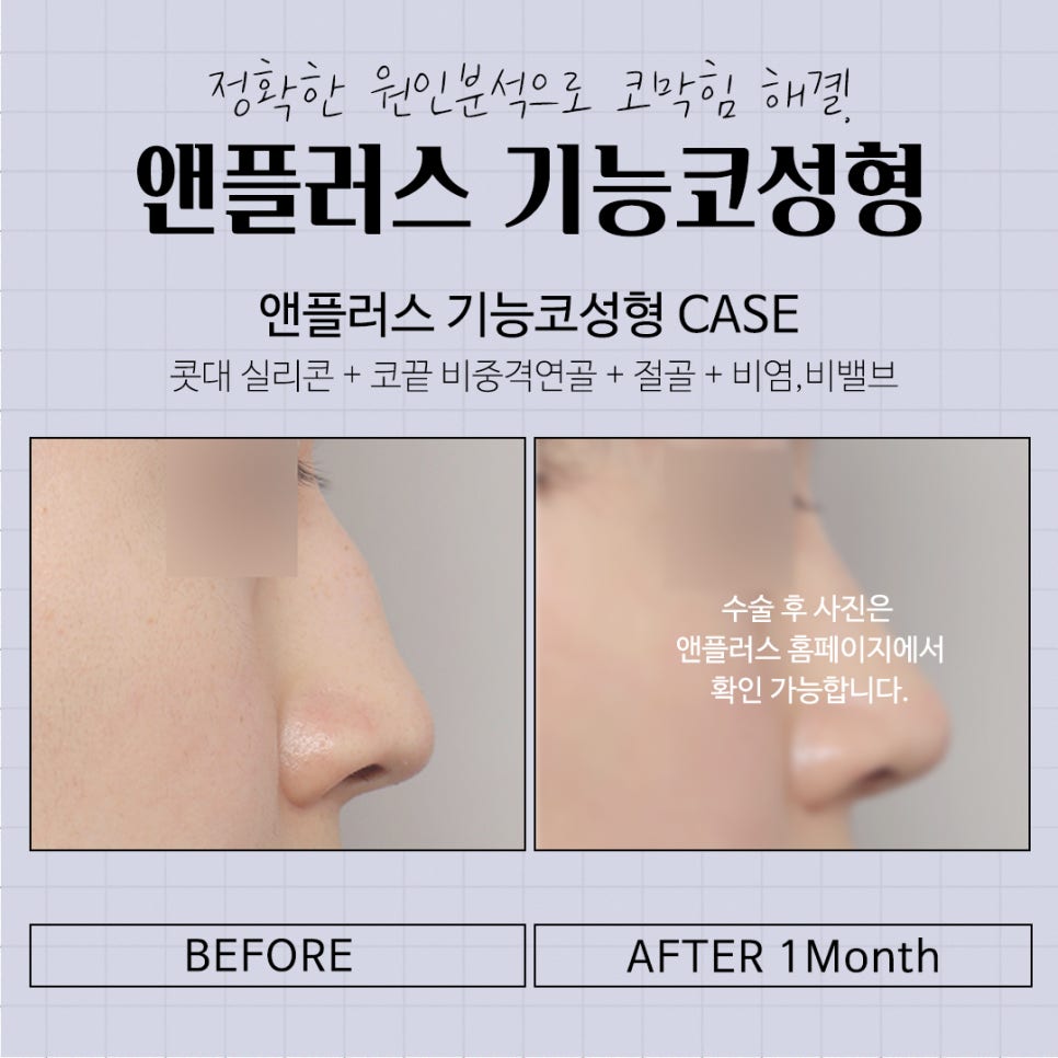 Learn More About Functional Nose Surgery Medical Expense Coverage image 12