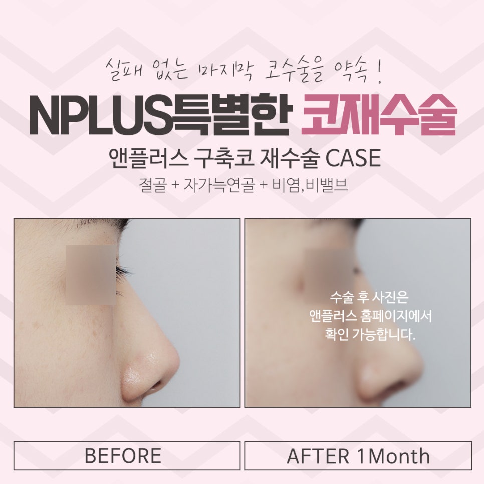 Review of Revision Rhinoplasty: Exploring Various Aspects image 15