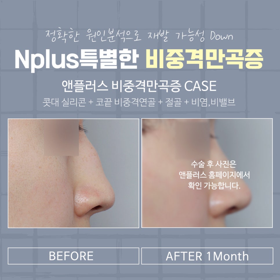 비중격만곡증수술 후기까지 확인하여 관련 이미지 14