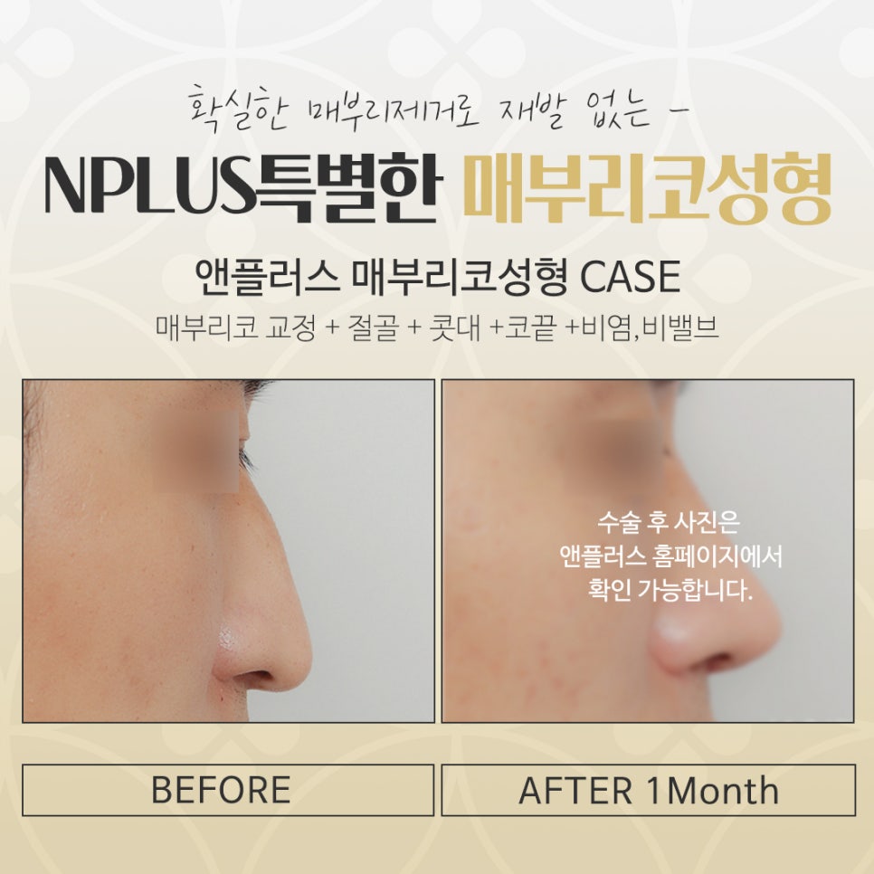 매부리코수술후기 확실하게 확인하여 관련 이미지 16