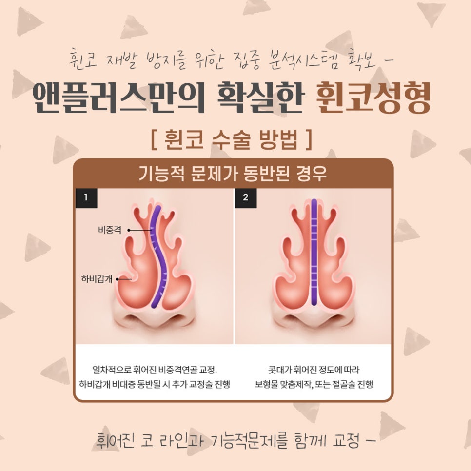 Crooked Nose Surgery Review, Including Functional Improvement image 10