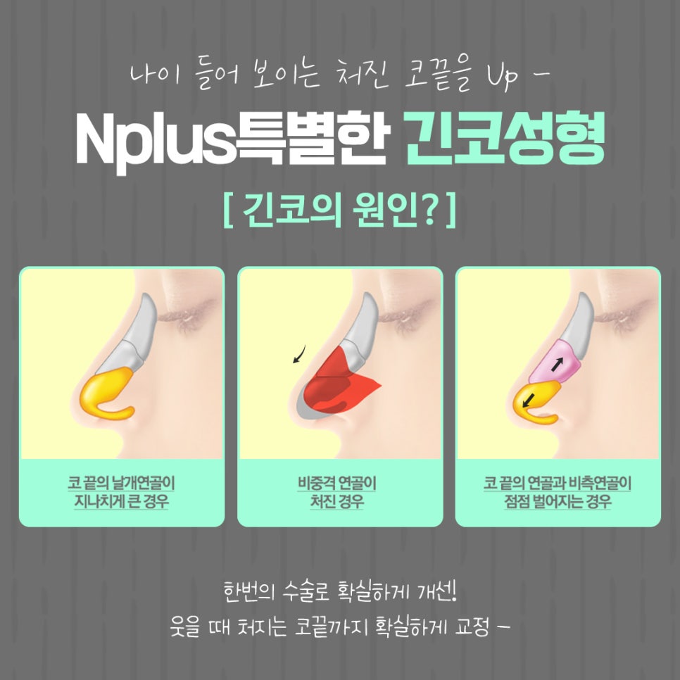 긴코수술 후기까지 확인하고 선택 관련 이미지 8