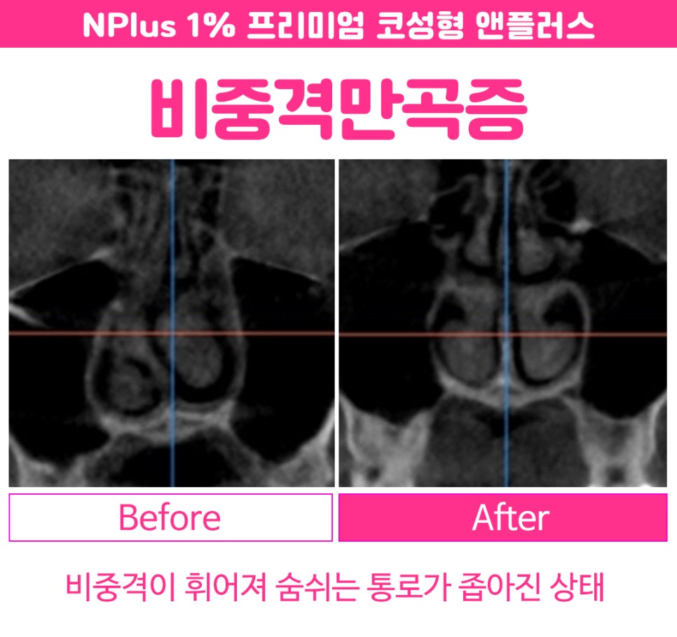 Septoplasty Surgery: A Careful Look From the Inside image 2