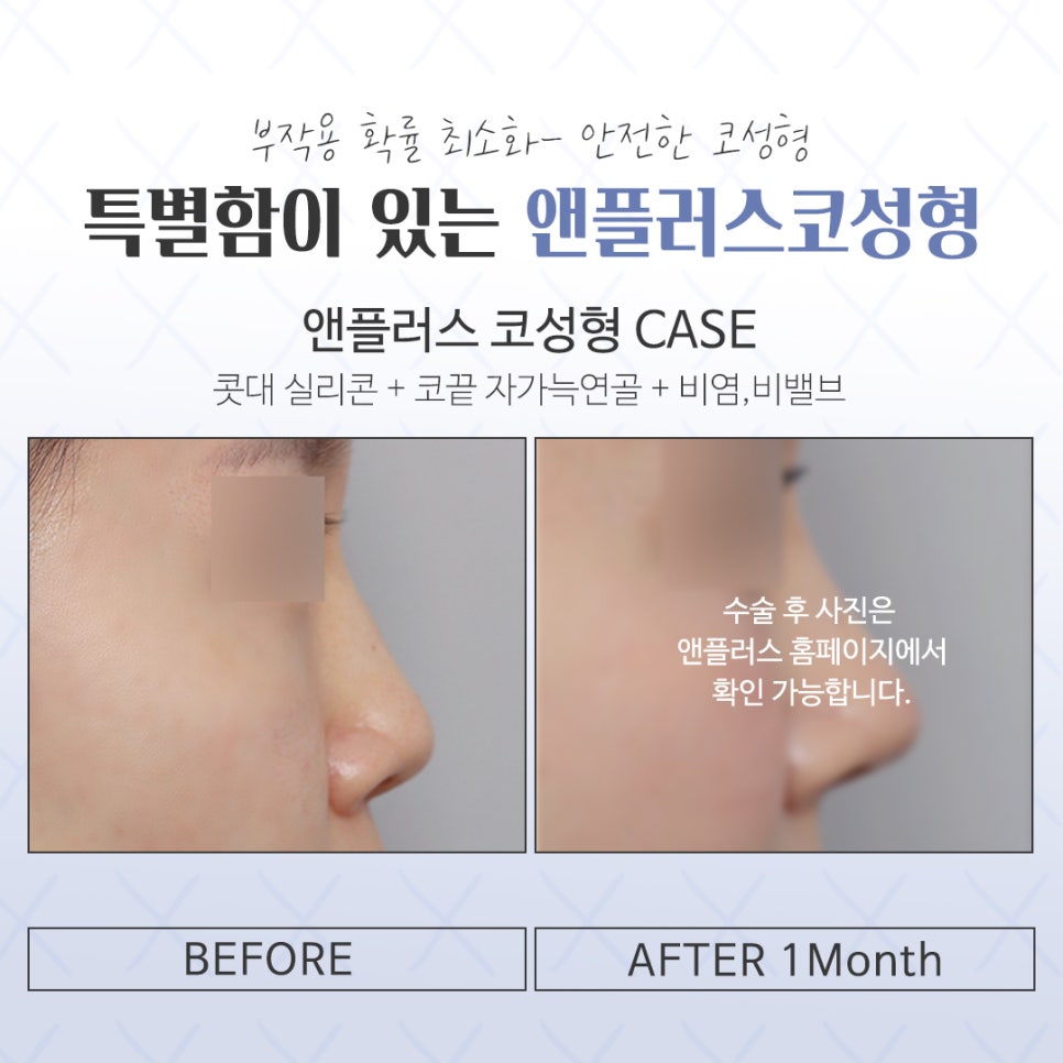 코성형전후 개선할 점을 확인하고 관련 이미지 16