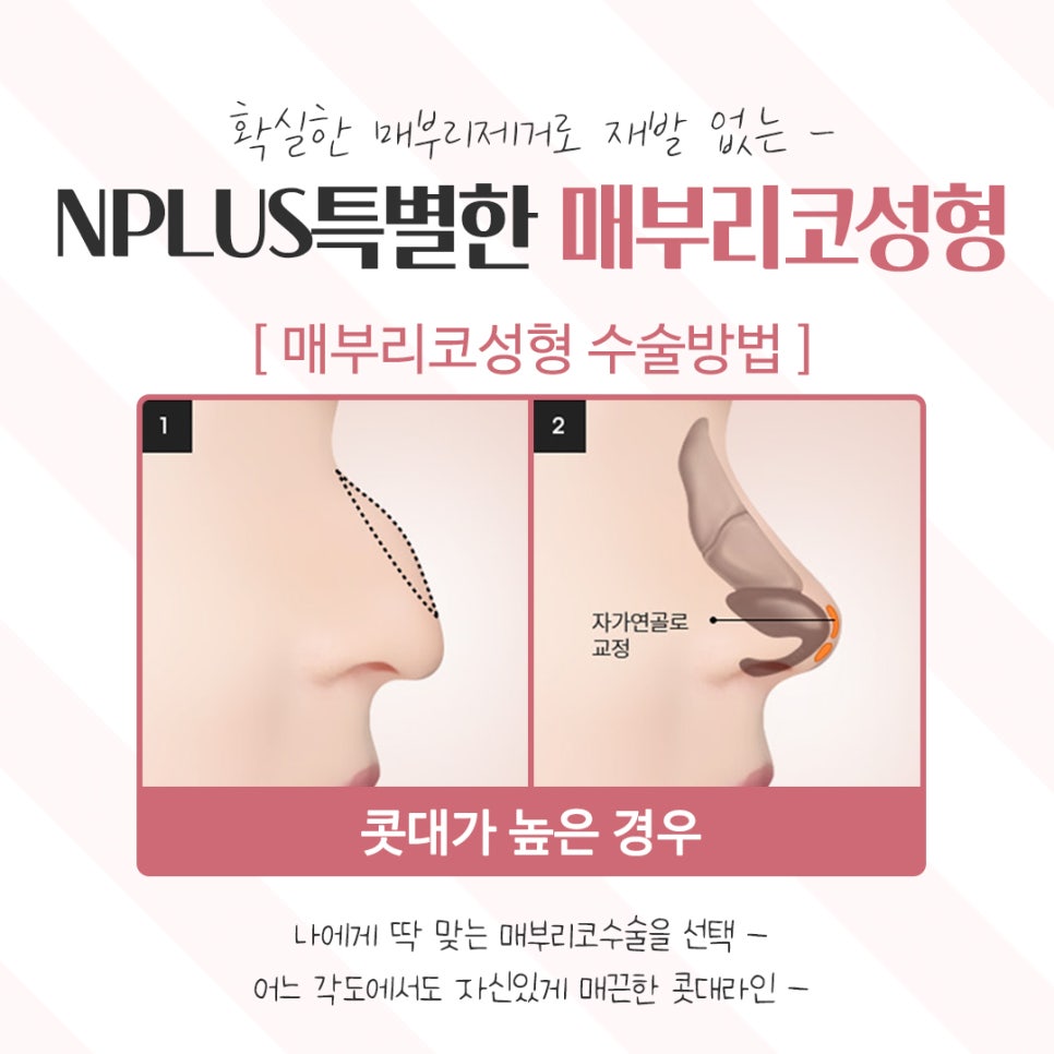 Taking a Detailed Look at Hump Nose Surgery Reviews image 9