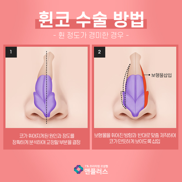 Crooked Nose Surgery at N+ image 6