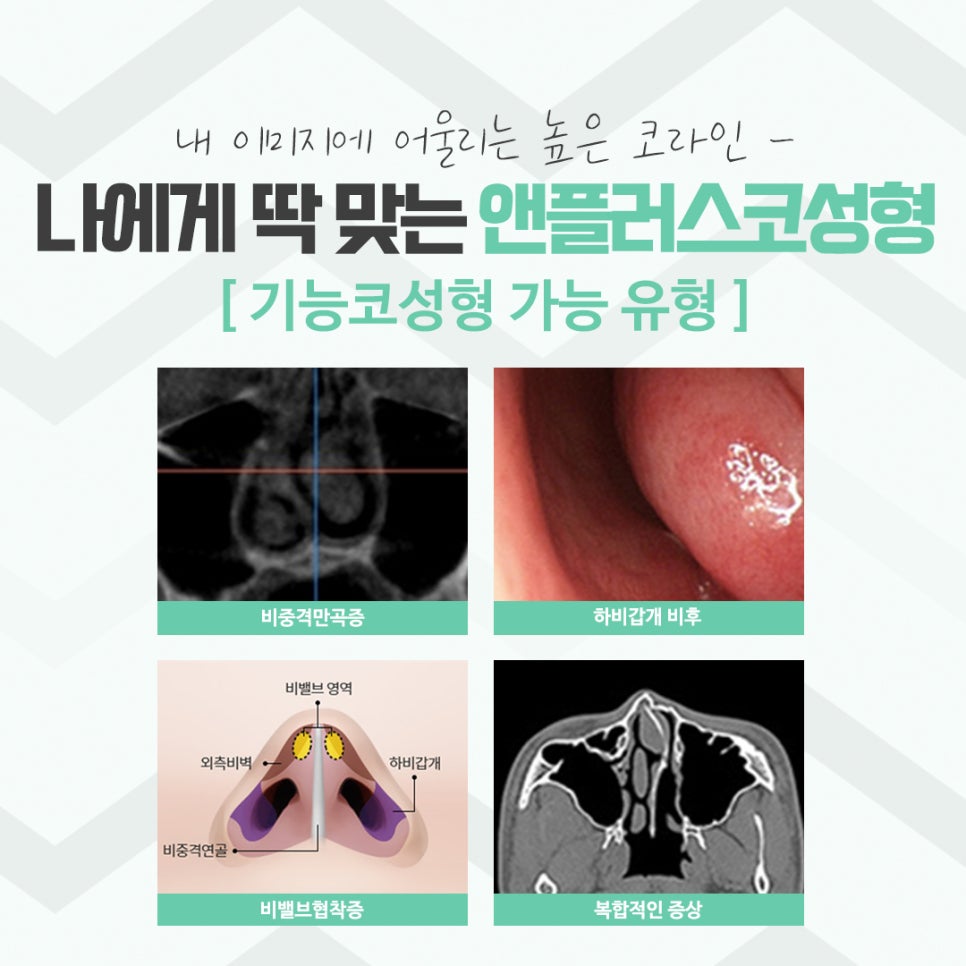 코성형후기 자연스러운 코라인으로 관련 이미지 6