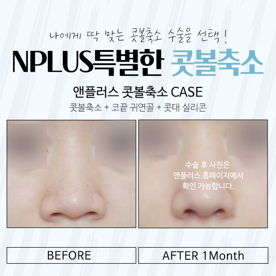 Natural Progress in Nasal Alar Reduction Surgery Review image 13