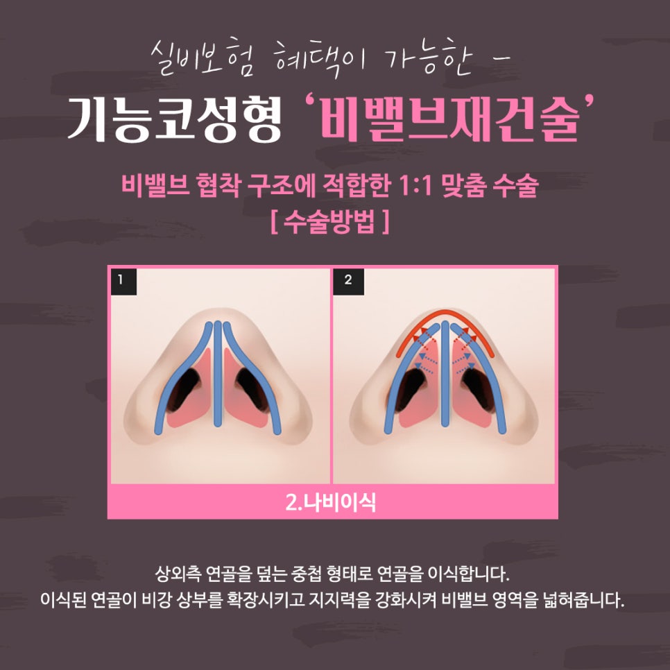 비밸브재건술 확실한 강남앤플러스에서 관련 이미지 11
