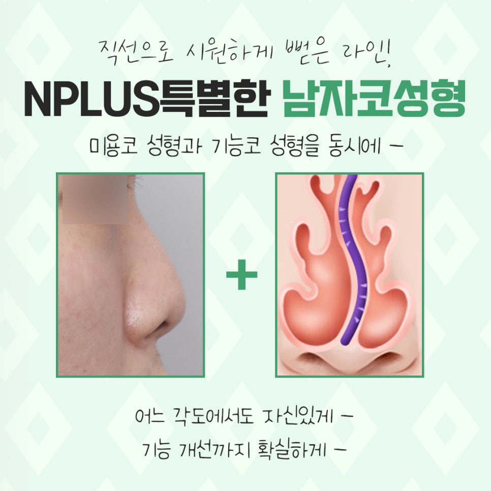 남자코수술후기 멋있고 자연스러운 라인으로 관련 이미지 4
