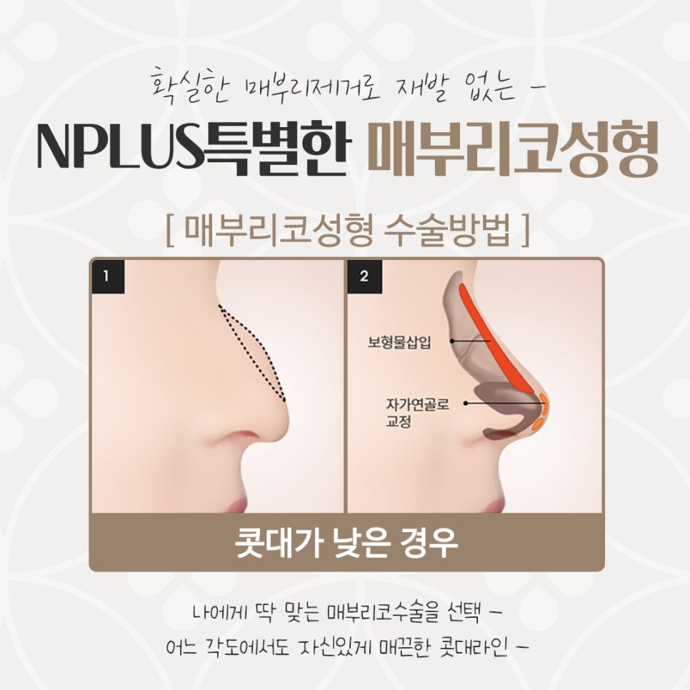Checking a Hump Nose Surgery Review in Various Ways image 9