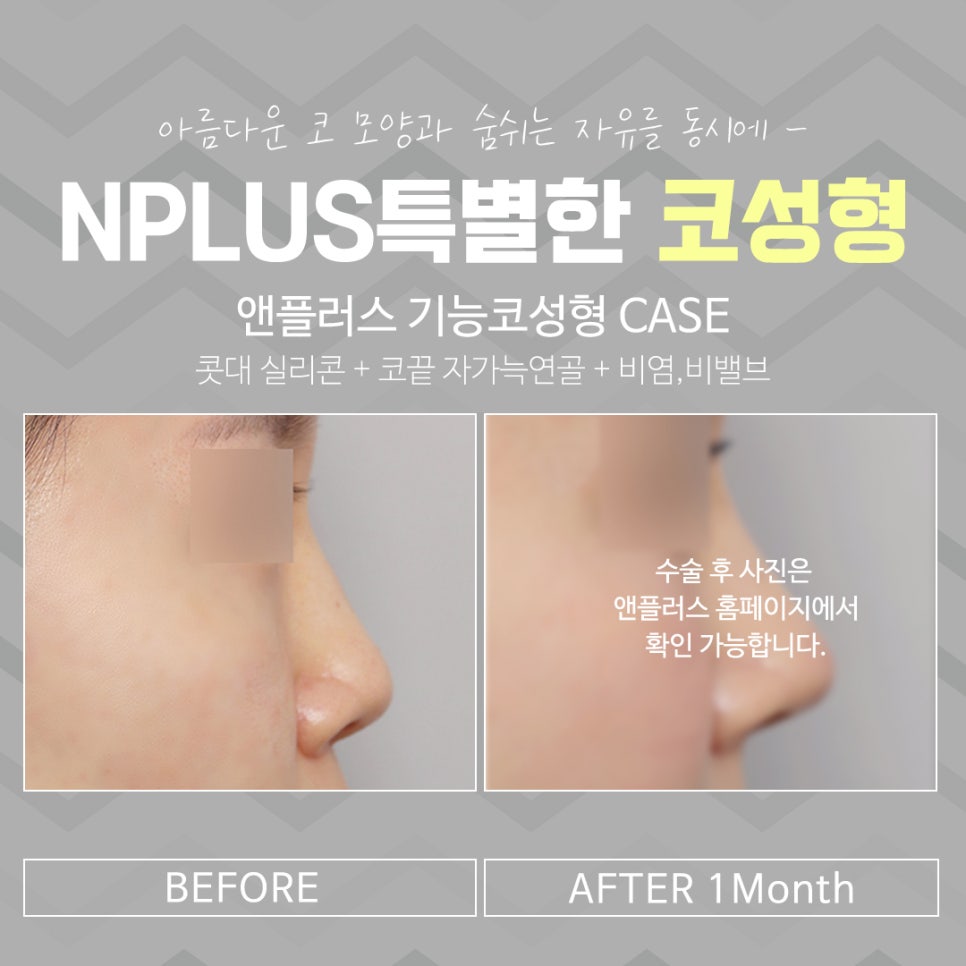 코수술전후 확실한 변화로 관련 이미지 16