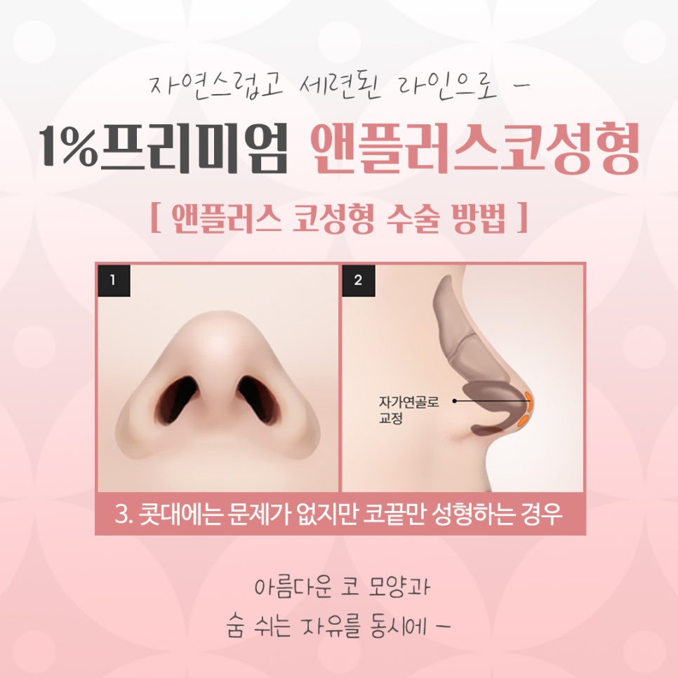 늑연골코수술을 통해 세련된 라인으로 관련 이미지 10