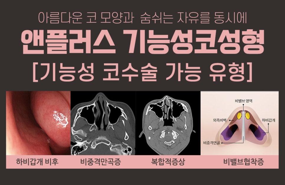 보험이 되는 코성형? 기능성코성형 완벽 정리! 관련 이미지 2