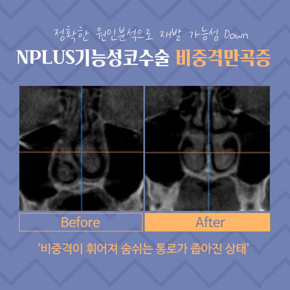 비중격만곡증수술 후기까지 꼼꼼하게 알아보고 관련 이미지 3
