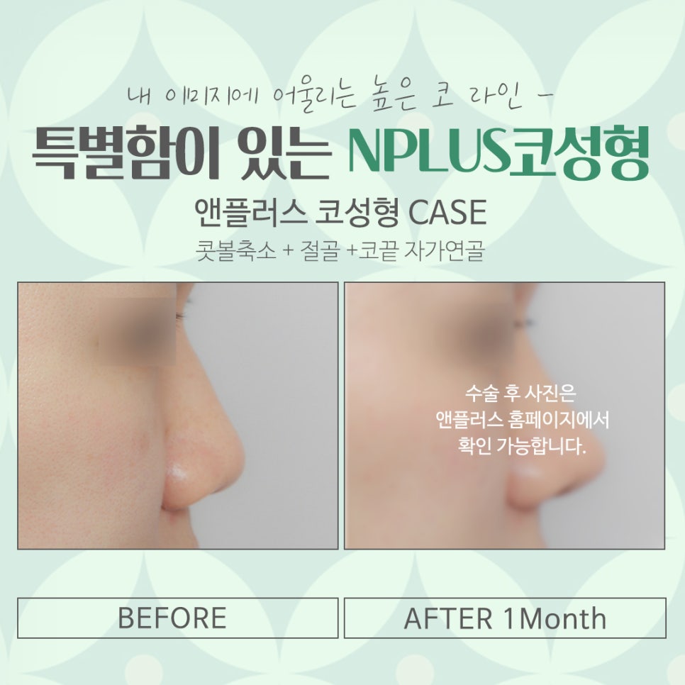 Looking into a Nose Surgery Clinic in Detail image 14