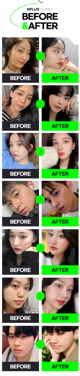앤플러스에서 진행하는 기능코성형 EVENT 관련 이미지 9