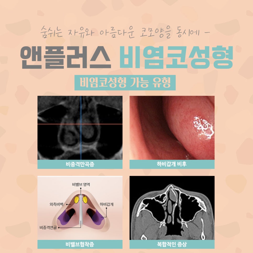 오지코에서 알려드리는 비염코수술 관련 이미지 7