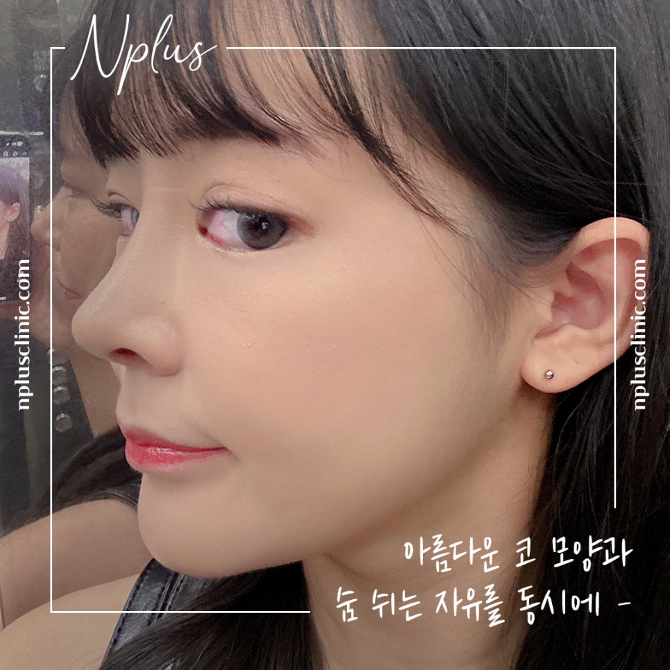늑연골코성형을 고민한다면 관련 이미지 10