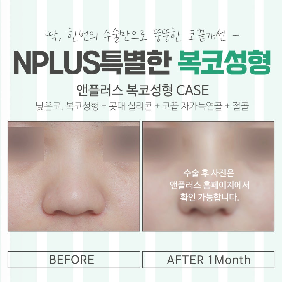 Looking Into Bulbous Nose Surgery Reviews to Improve Your Appearance image 16