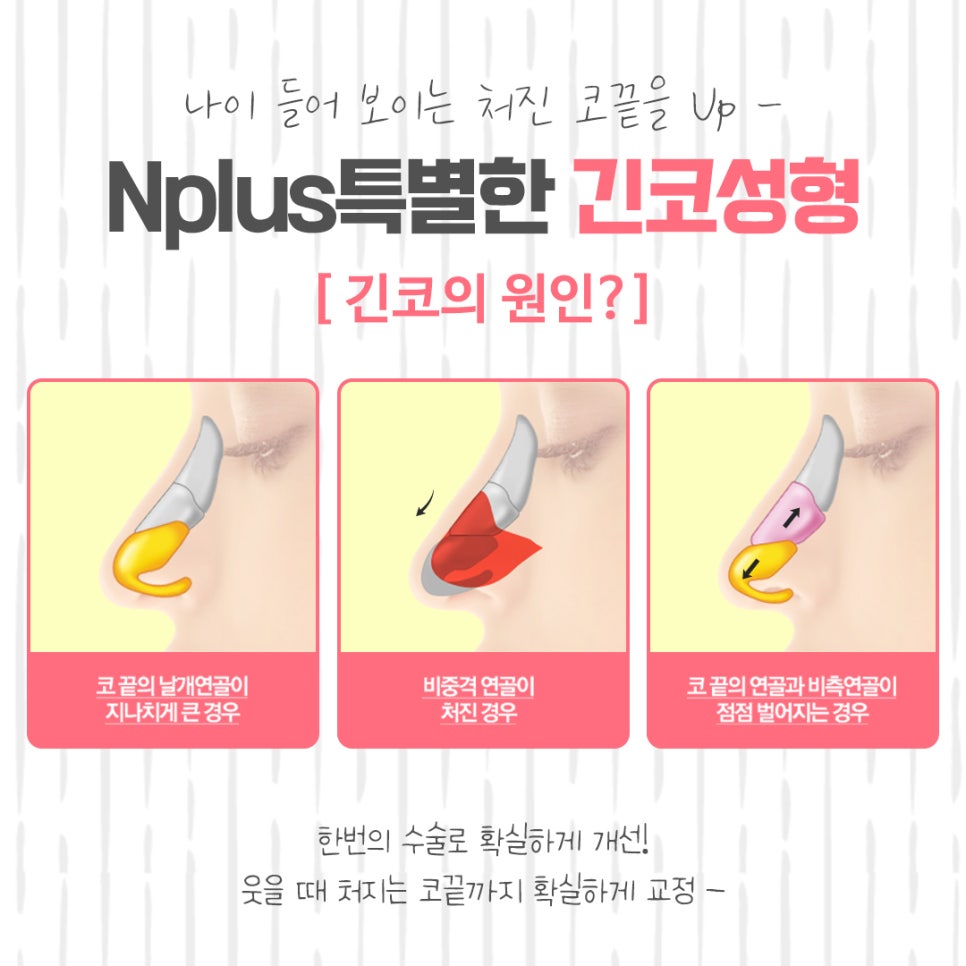 긴코성형 후기까지 알아보고 관련 이미지 4