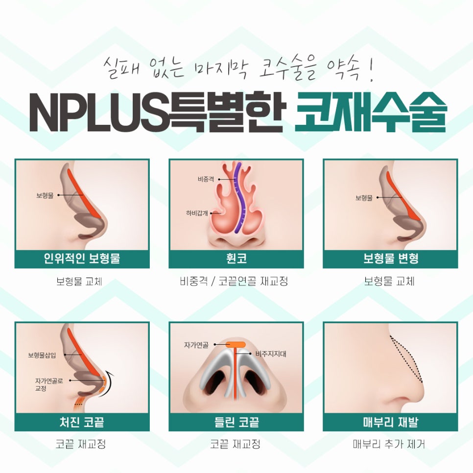 Male Nose Revision Surgery with a Thorough Diagnosis image 9