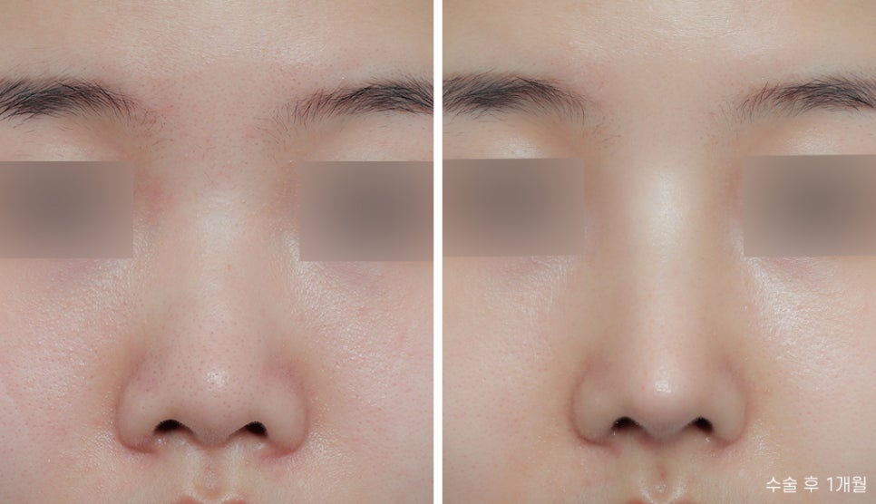 Let’s Find Confidence with a Small, Low Nose and a Beautiful Nose Shape! image 2