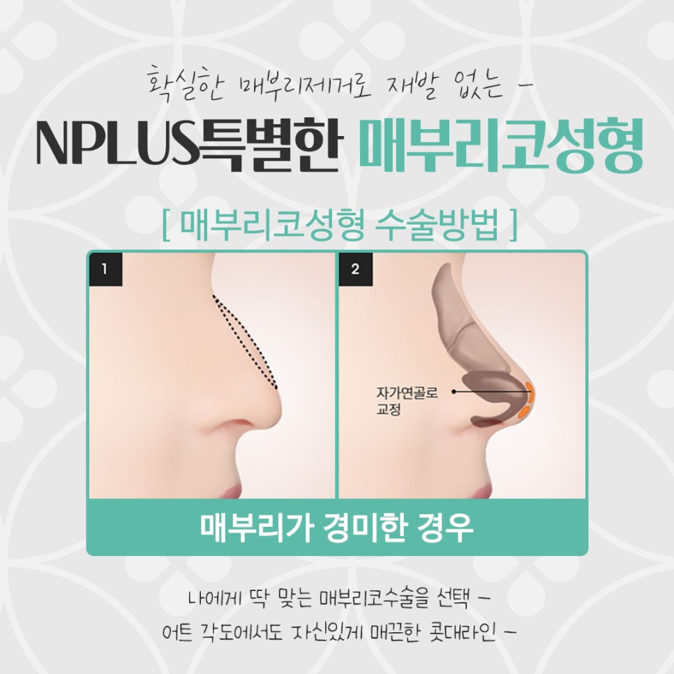 매부리코성형후기 부드러운 인상으로 관련 이미지 12