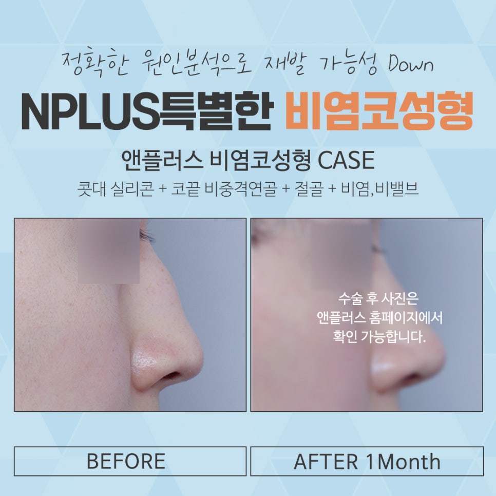 비염수술코성형 한 번의 선택으로 관련 이미지 13