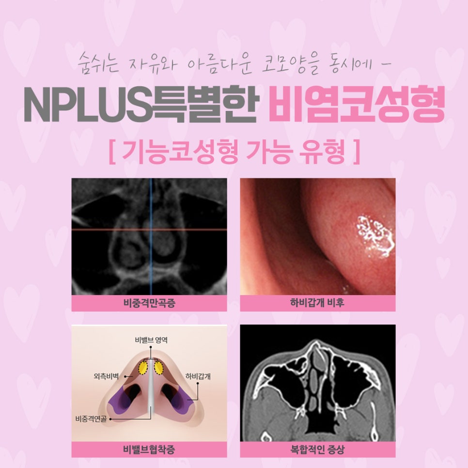 비염코수술 원인을 정확하게 파악하고 관련 이미지 5