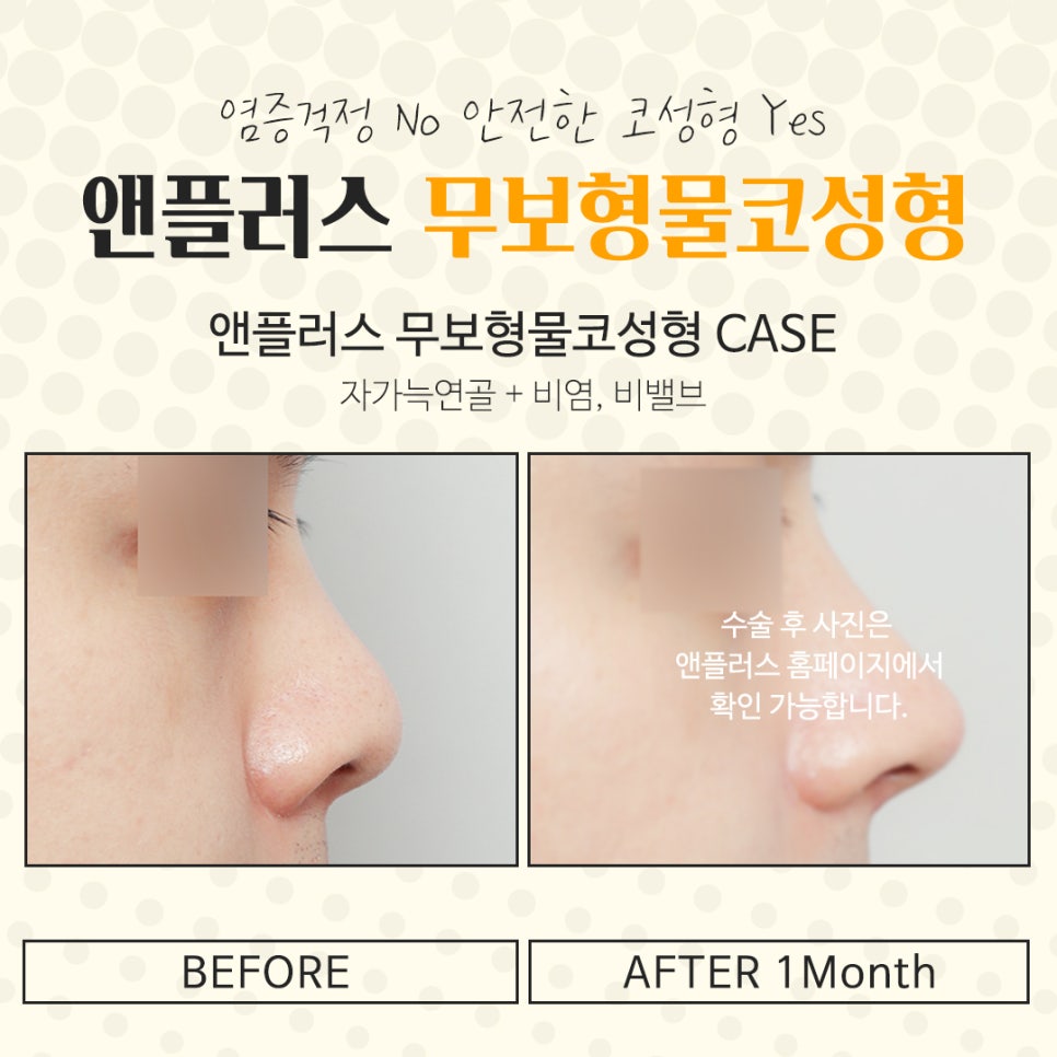 무보형물코수술에 대해 자세하게 알아보고 관련 이미지 13