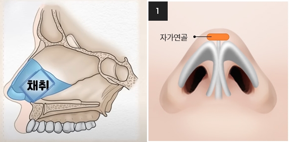 기능코성형 실비 어떤 경우에 받을 수 있는지? 관련 이미지 10