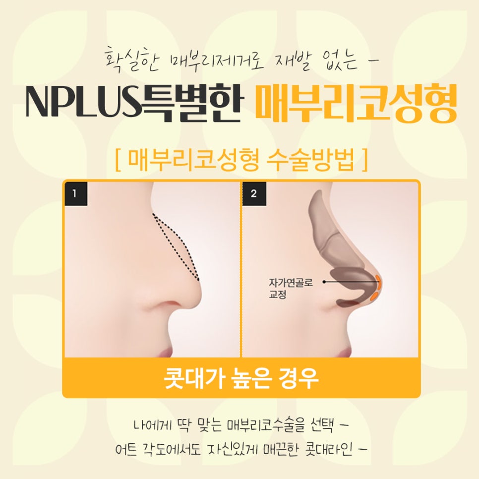 Detailed Review of Hump Nose Surgery, Including Function image 8