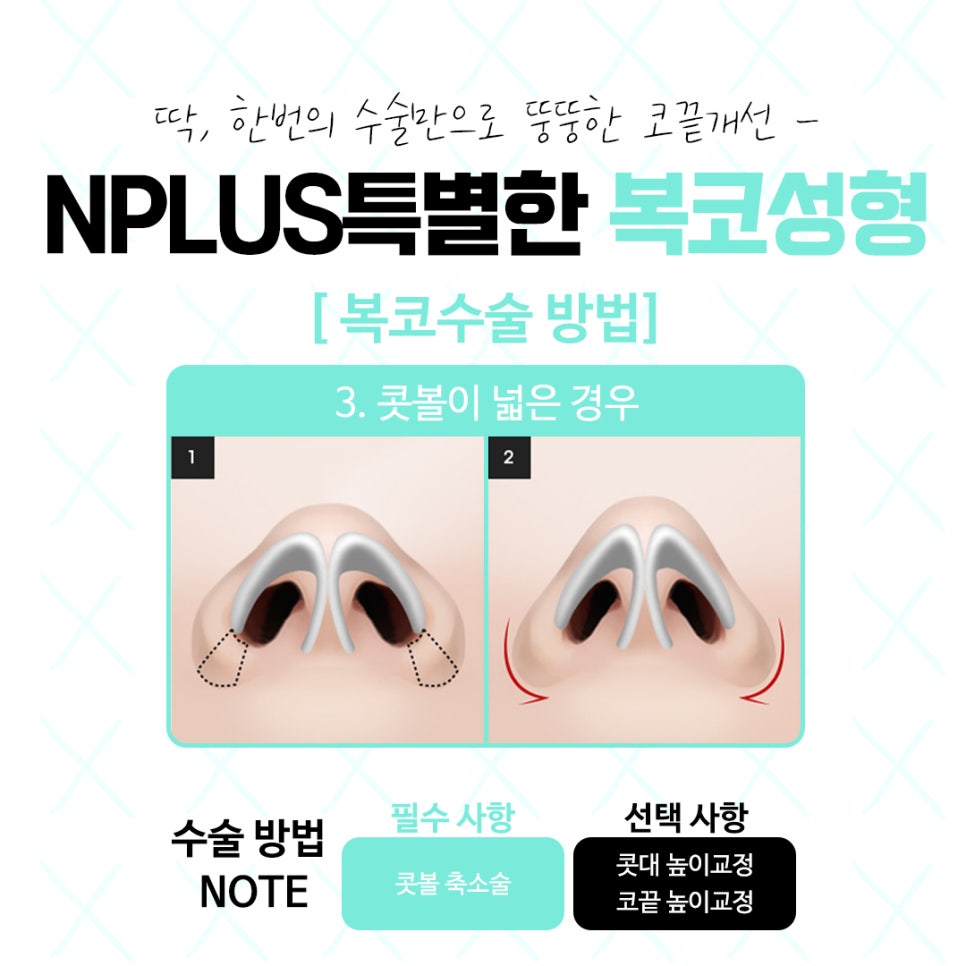 복코수술후기를 더욱 자세히 확인하고 관련 이미지 9