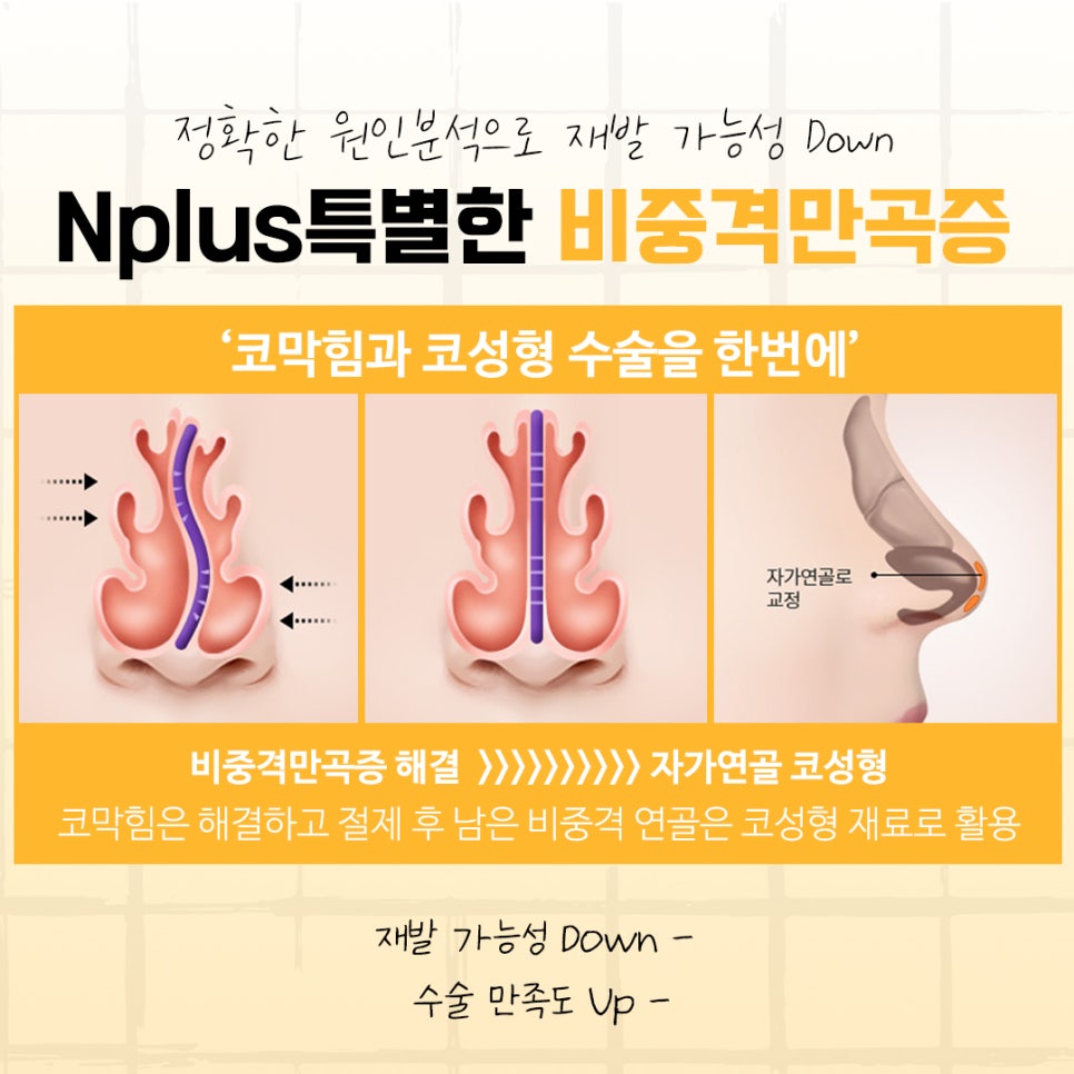 비중격만곡증수술후기에 대해 신중하게 찾아보고 관련 이미지 9