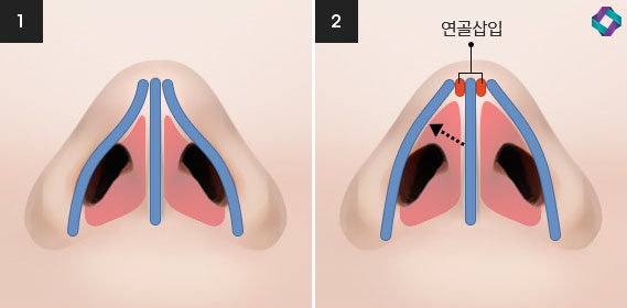 기능코성형 비중격만곡증(비중격교정술)과 코막힘원인 관련 이미지 11