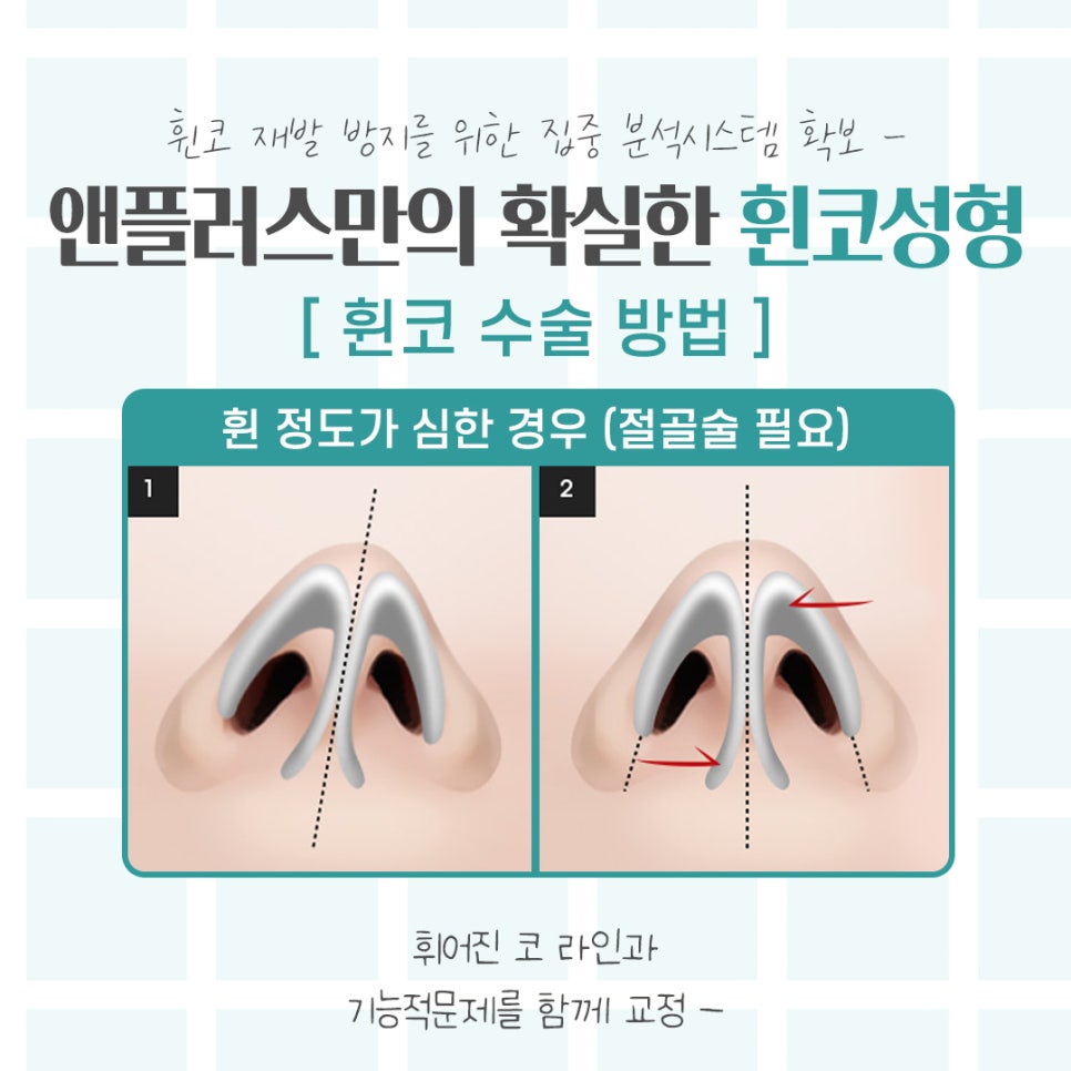 Understanding the Issues in Crooked Nose Surgery Accurately image 8