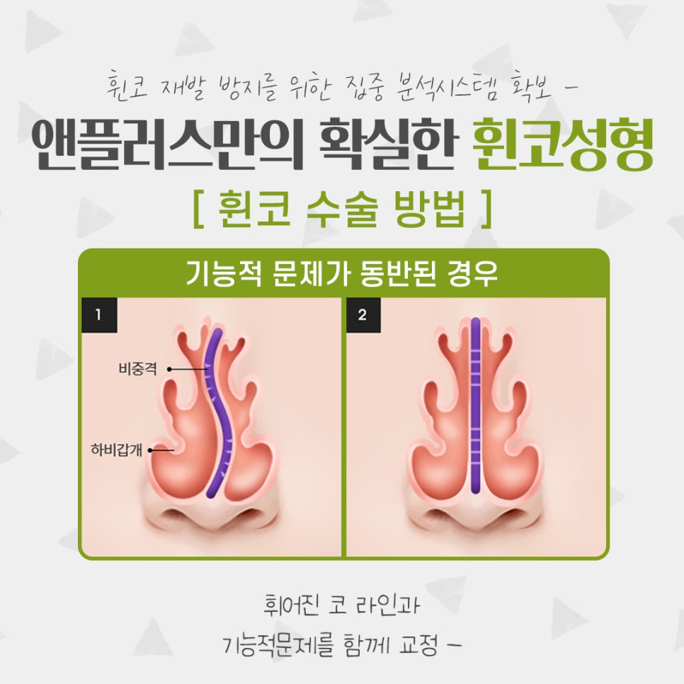 Whistling Nose Surgery Review: A Natural and Beautiful Line image 9