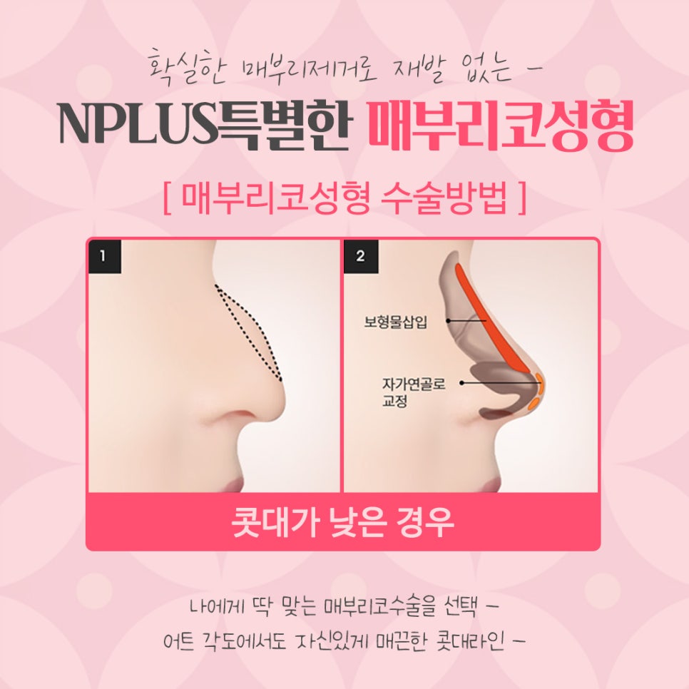 매부리코성형후기 내부까지 확인하고 관련 이미지 10