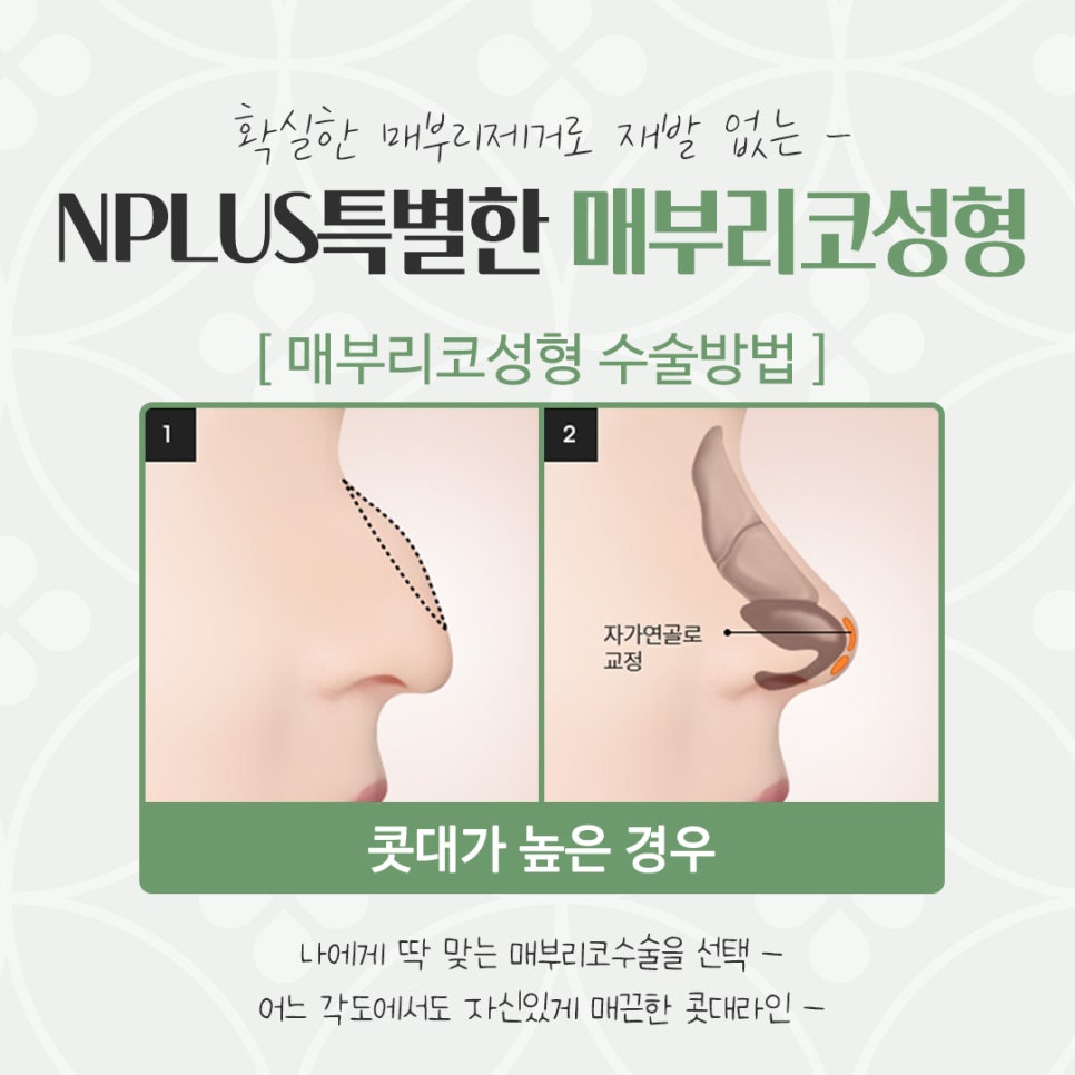 Hump Nose Surgery Review: Check Carefully image 8