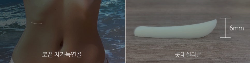 낮은코성형 비염수술도 예쁘게 관련 이미지 4