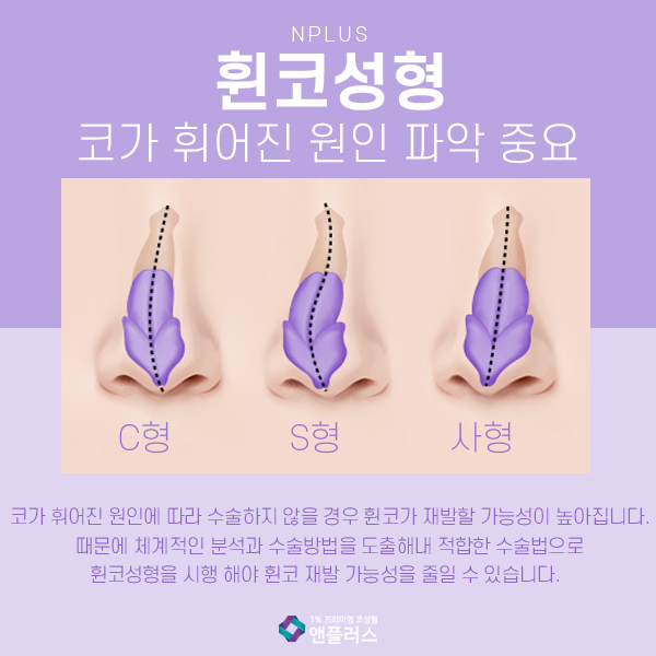 Crooked Nose Surgery at N+ image 3