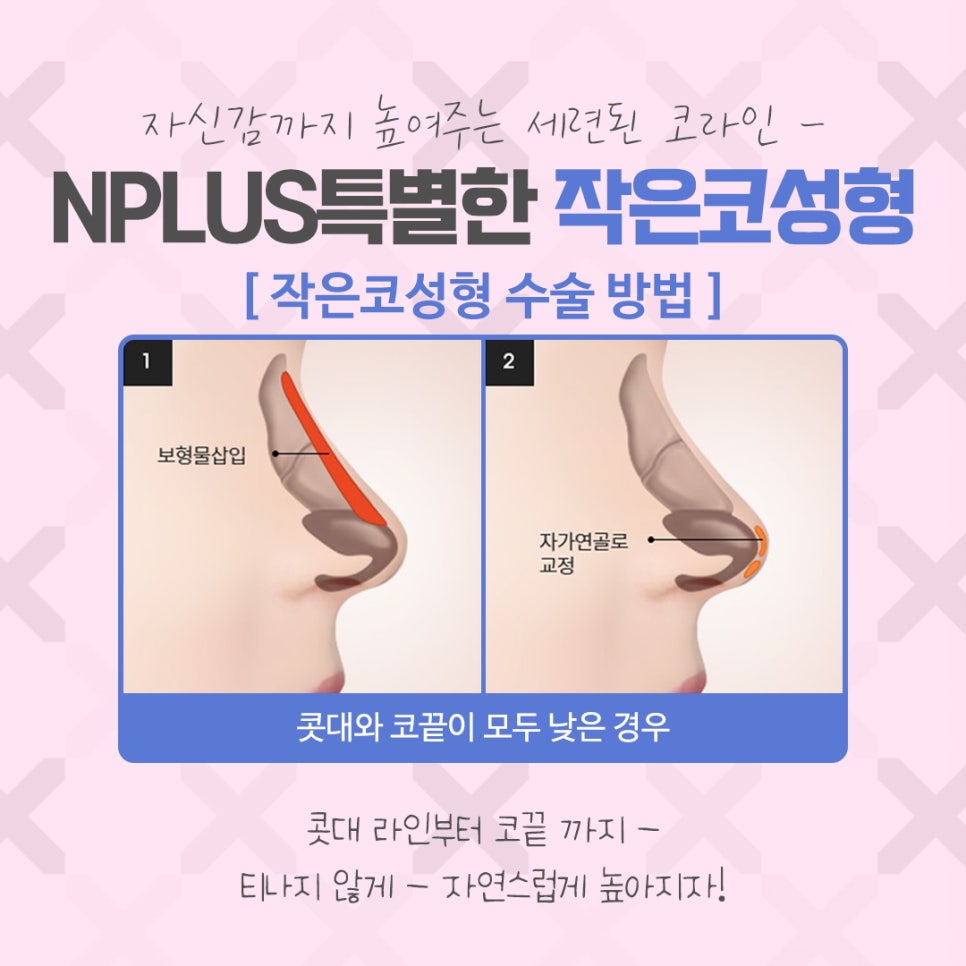 Carefully Reviewing Small Nose Surgery Reviews image 8