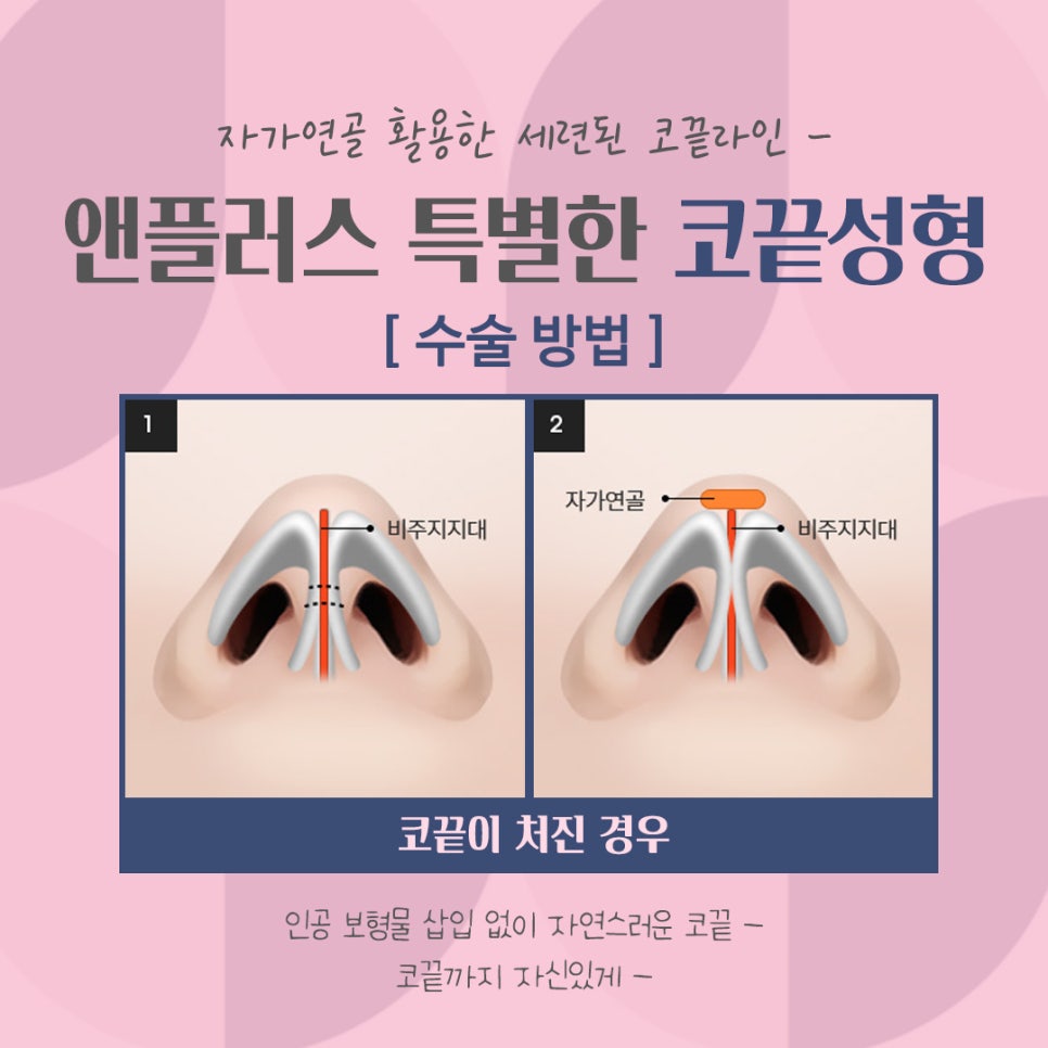 코끝처짐 개선한 코끝성형후기 관련 이미지 9