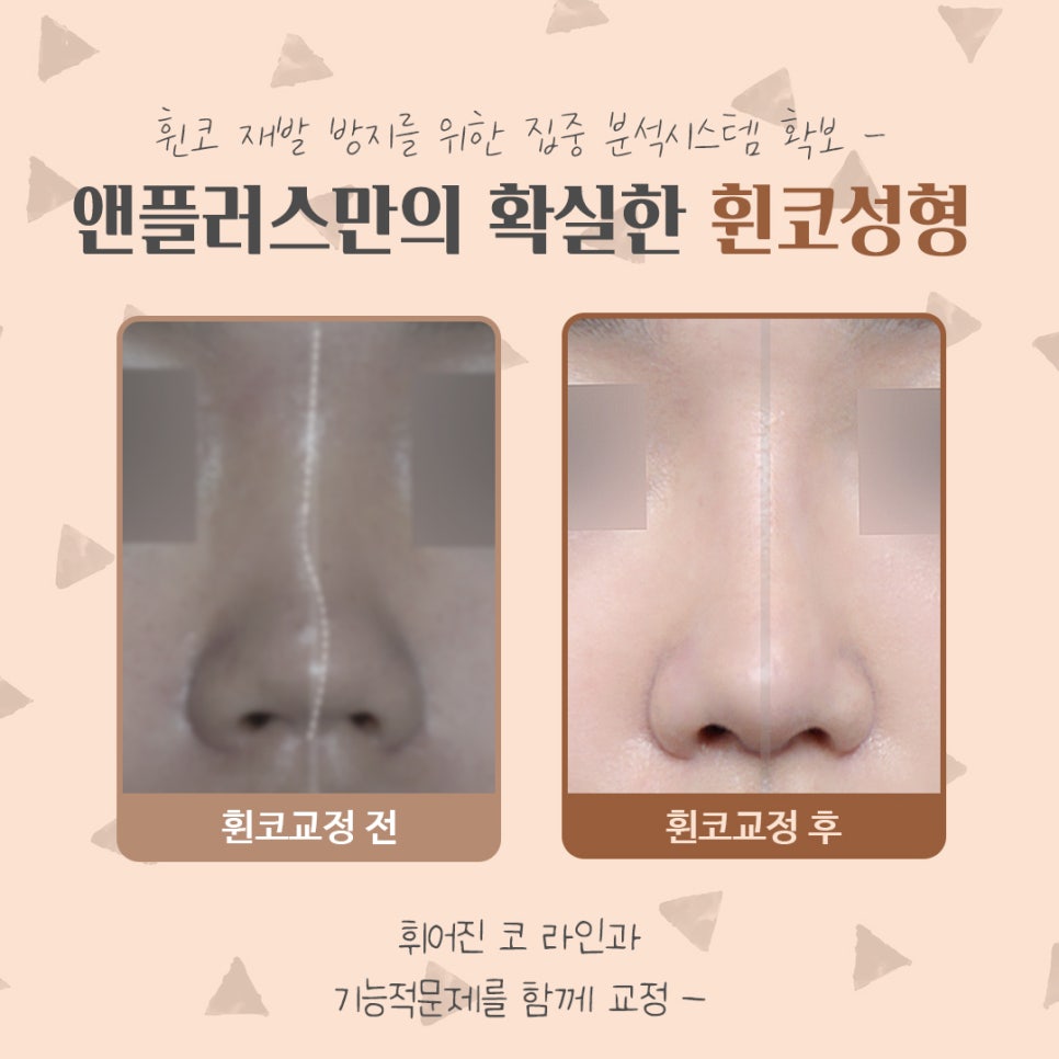 Crooked Nose Surgery Review, Including Functional Improvement image 5